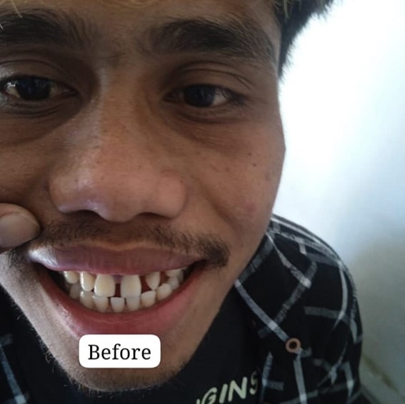 Sebelum perawatan gigi pasien