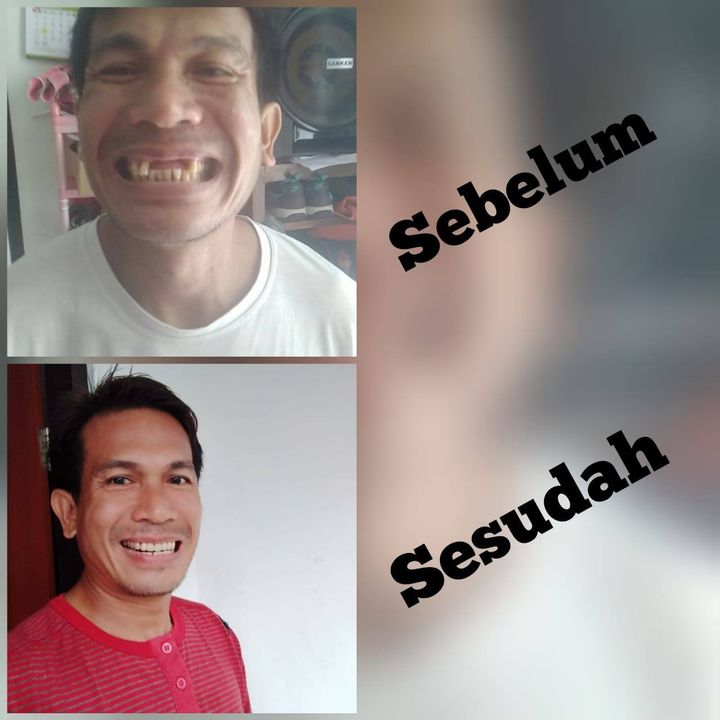 Perbandingan sebelum dan sesudah perawatan